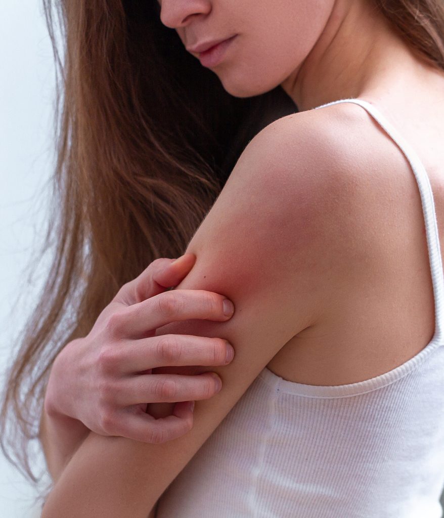 Woman scratching her arm due to skin issues.