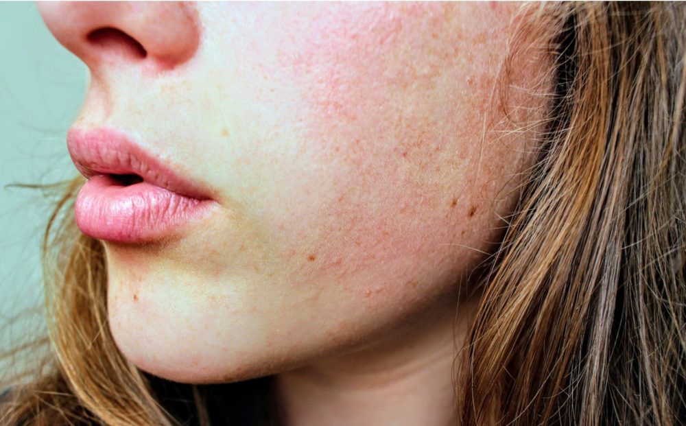 Close up of half a person face with skin irritation on cheeks.