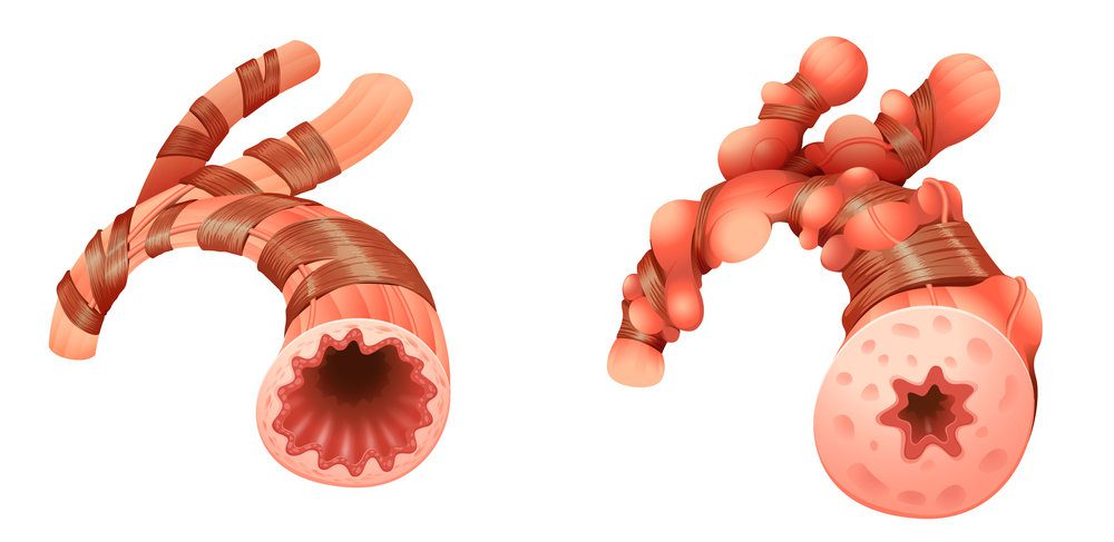 Representation of pulmonary arteries, a normal one and an inflamed one.